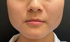 ボトックス治療前の写真