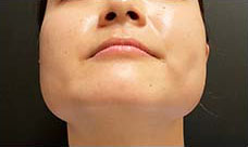 ボトックス治療前の写真