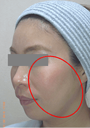 ボトックス治療後の写真