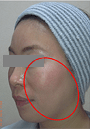 ボトックス治療前の写真