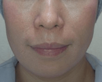 ボトックス治療前の写真