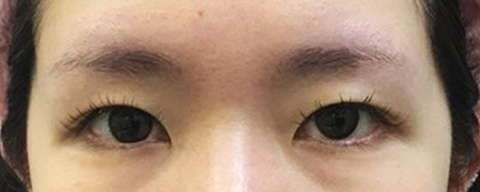 二重埋没前の写真