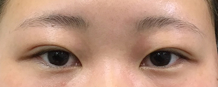 二重埋没後の写真