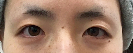 二重埋没前の写真