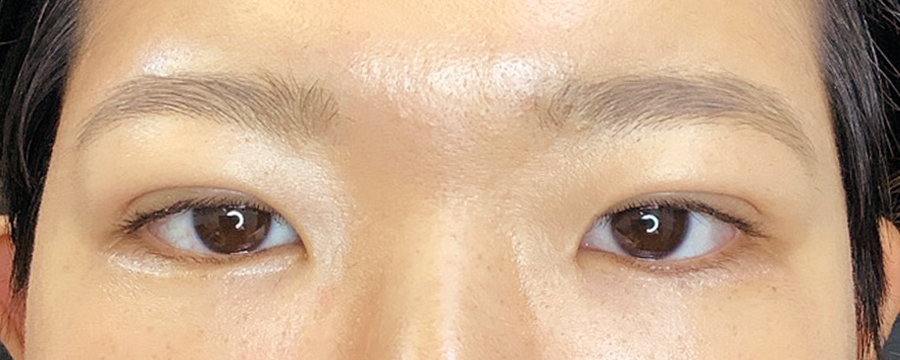 二重埋没後の写真