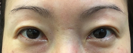 二重埋没前の写真