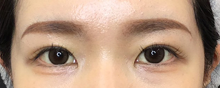 二重埋没後の写真