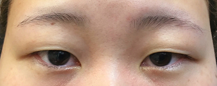 二重埋没前の写真