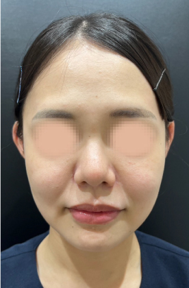 ヒアルロン酸注入後の写真