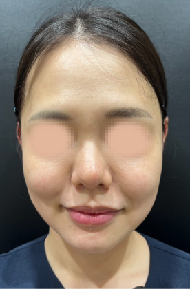 ヒアルロン酸注入前の写真