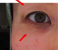 ヒアルロン酸注入後の写真