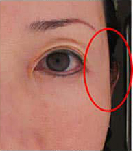 ヒアルロン酸注入後の写真