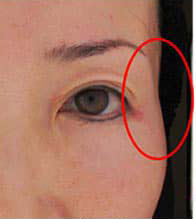 ヒアルロン酸注入前の写真