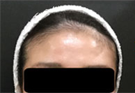 ヒアルロン酸注入前の写真