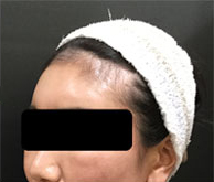 ヒアルロン酸注入後の写真