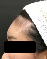 ヒアルロン酸注入後の写真