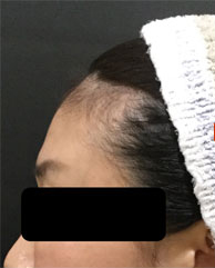 ヒアルロン酸注入前の写真