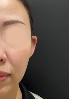 立ち耳ヒアルロン酸注入後の写真