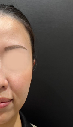 ヒアルロン酸注入前の写真