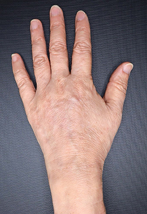 ヒアルロン酸注入後の写真