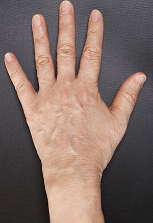 ヒアルロン酸注入前の写真