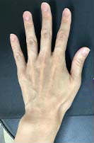 ヒアルロン酸注入前の写真