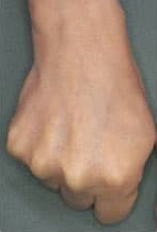 ヒアルロン酸注入後の写真