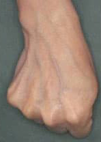 ヒアルロン酸注入前の写真