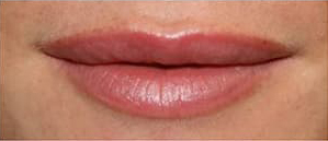 ヒアルロン酸注入後の写真