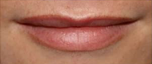 ヒアルロン酸注入前の写真