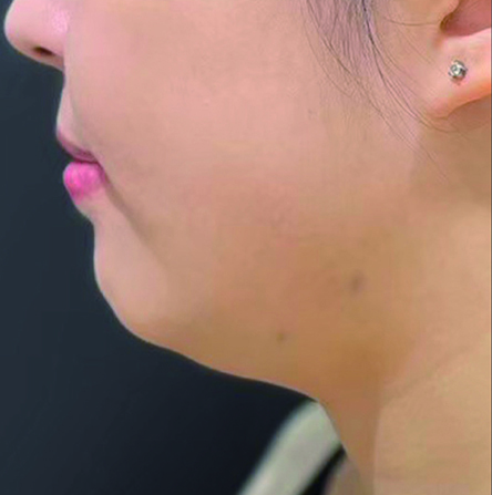 FatXcore治療直後の写真