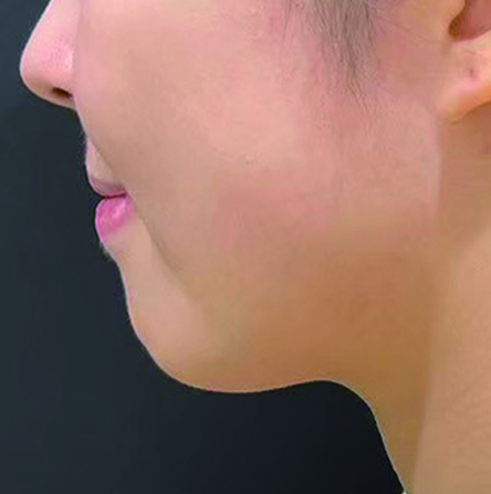 FatXcore14日後の写真