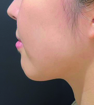 FatXcore1カ月後の写真