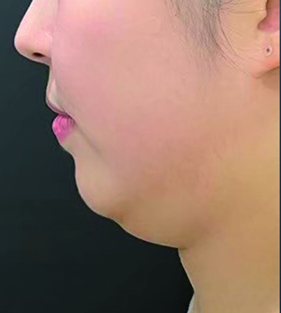 FatXcore治療前の写真