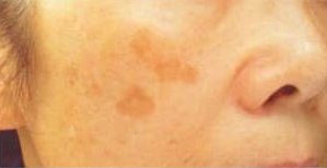 ノーリス治療前の写真