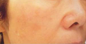 ノーリス治療後の写真