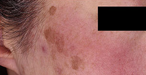 ノーリス治療前の写真