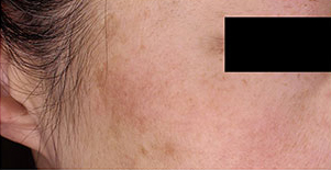 ノーリス治療後の写真