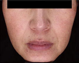 ノーリス治療後の写真