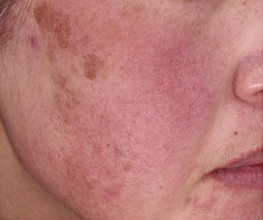 ノーリス治療前の写真