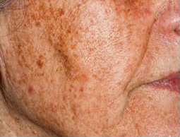 ノーリス治療前の写真