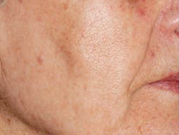 ノーリス治療後の写真