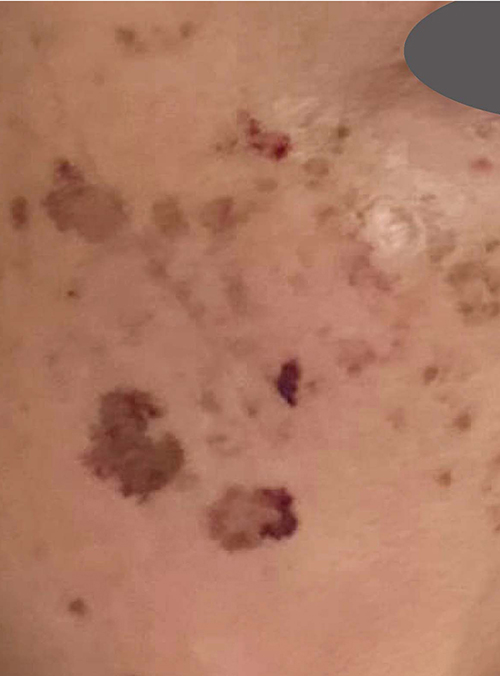 しみレーザー治療当日の写真