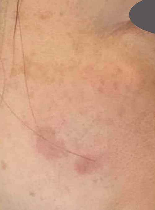 しみレーザー2カ月後の写真