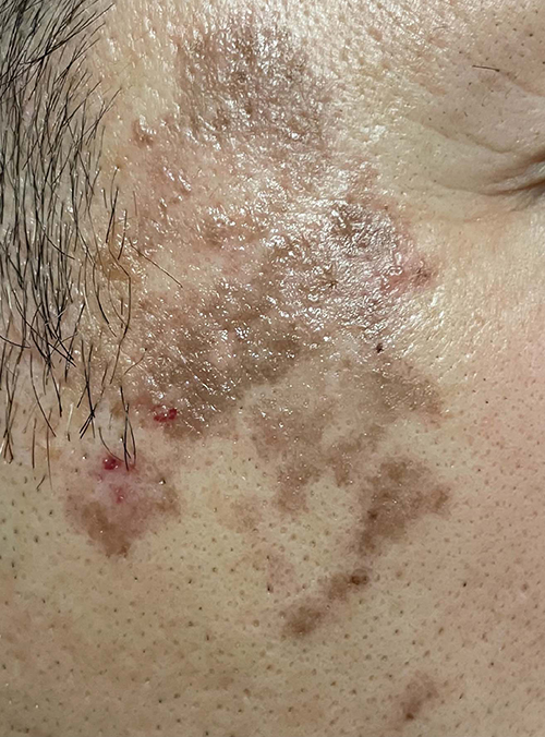 しみレーザー治療前の写真