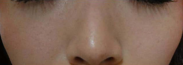 レーザー治療後の写真