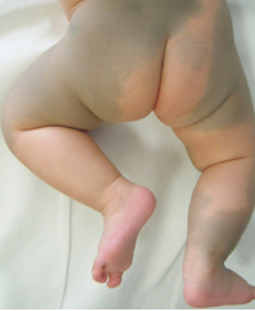 異所性蒙古斑治療前の写真