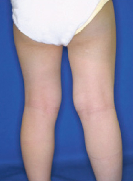 異所性蒙古斑治療後の写真