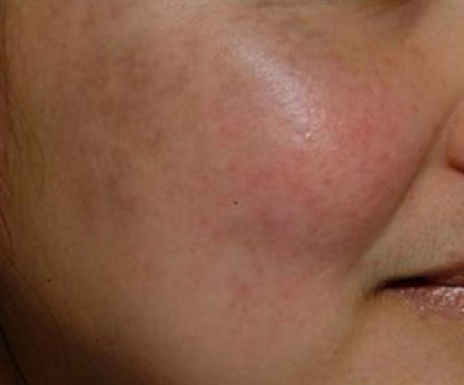 太田母斑治療後の写真