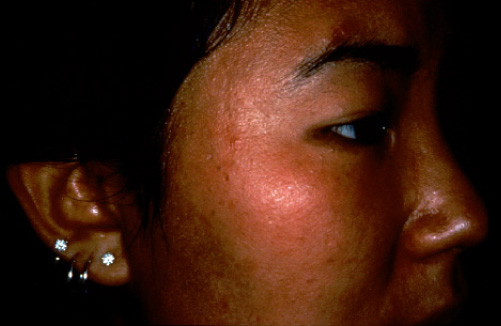 太田母斑治療後の写真